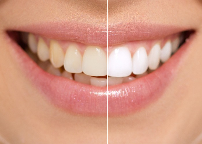 Teeth Whitening Options